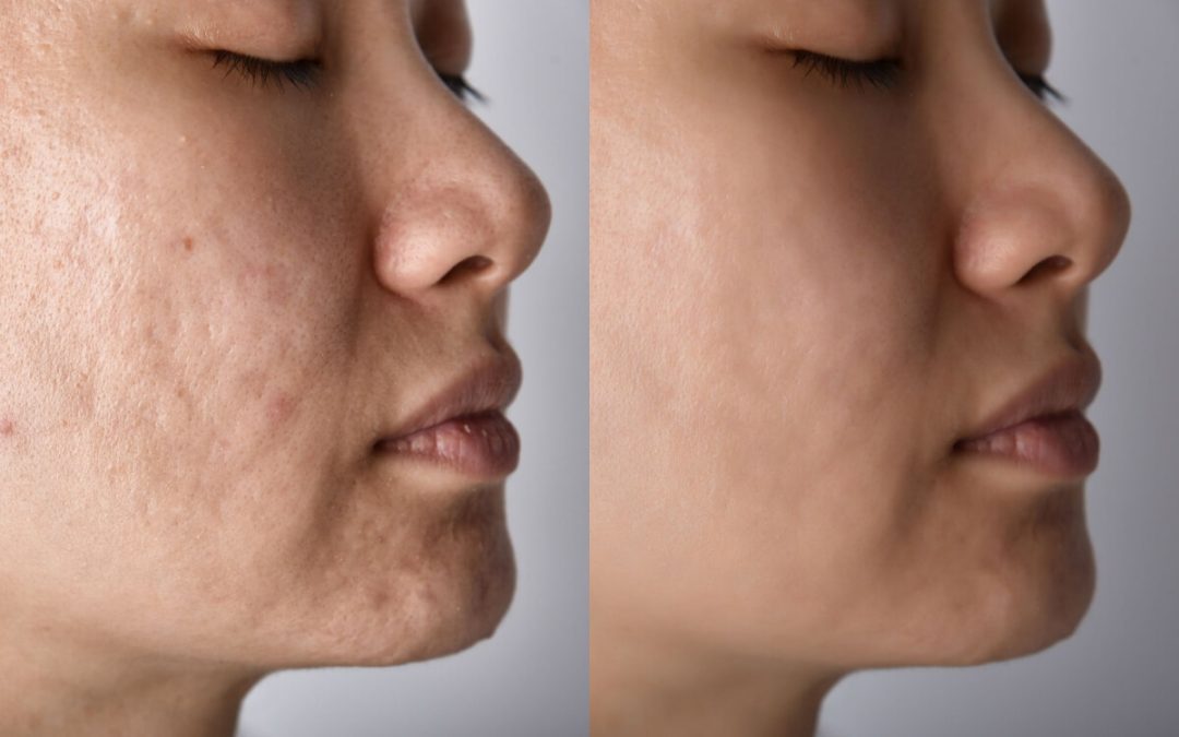 Learn More About Acne Treatment